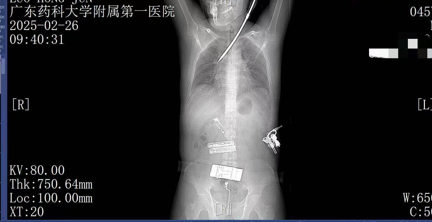 20米高空掉落螺丝刀直插男子胸腔！医生：不要自行拔除